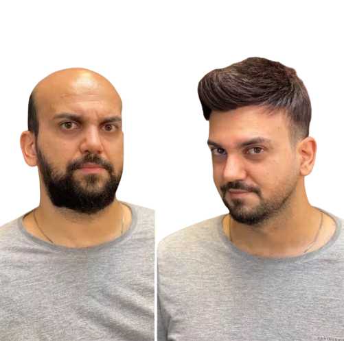 Permanent hair wigs for men