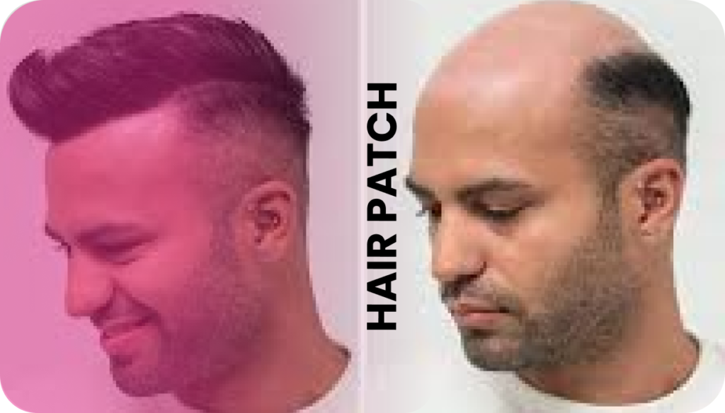 best hair patches in hyderabad